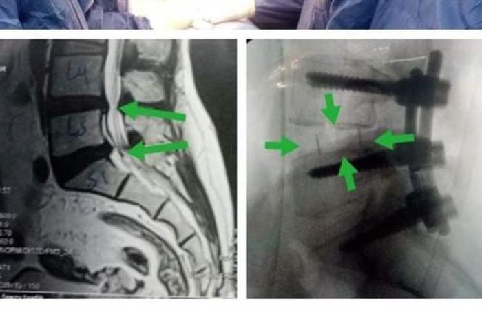 فريق جراحى بكفر شكر التخصصى ينقذ مريضة من الإصابة بالشلل بعد تركيب قفص كربوني