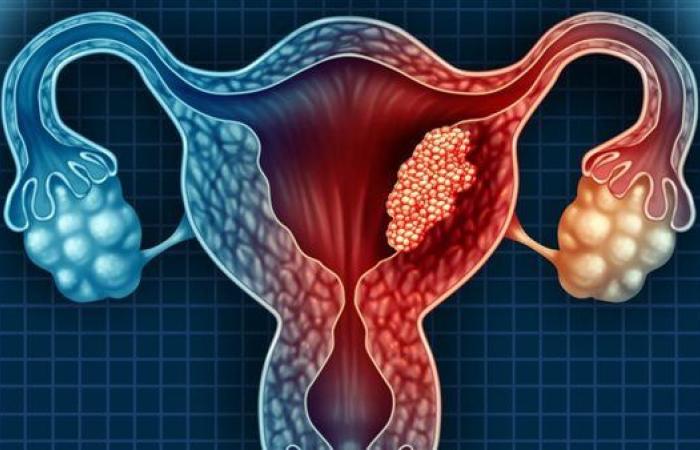 بالبلدي : باحثون يطورون تقنية جراحية دقيقة لإزالة العقدة الليمفاوية في سرطان بطانة الرحم| تفاصيل